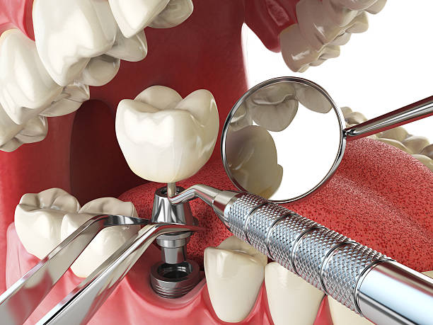Best Emergency Tooth Extraction in Reedspt, OR